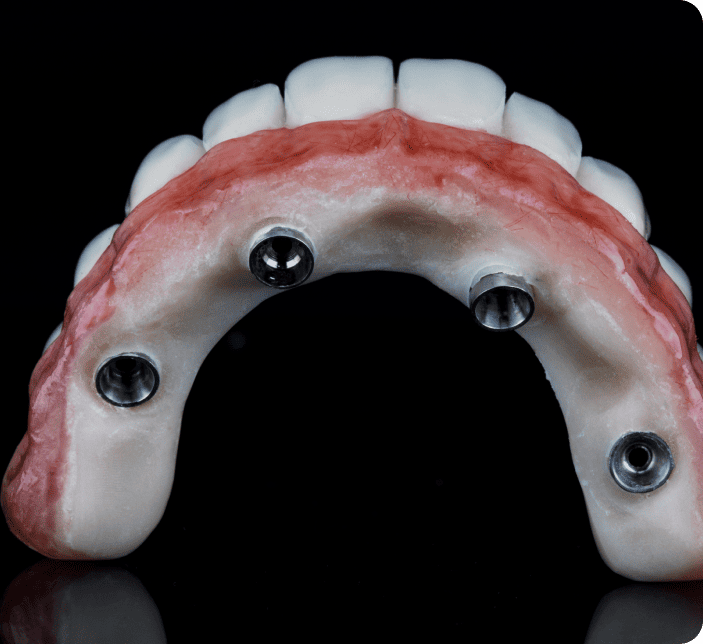 Denture-with-Ball-Socket-Attachments