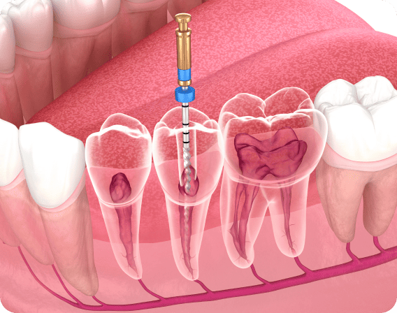 How-is-a-Root-Canal-Performed_