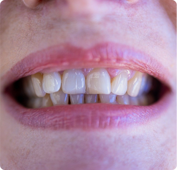 Gummy Smile