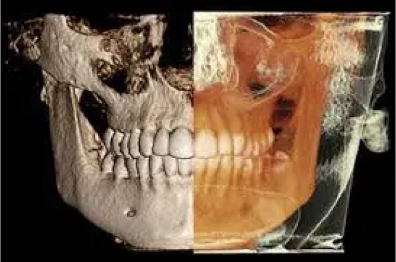 Intraoral Scanning Img