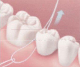 Using a floss threader, insert floss under the bridge