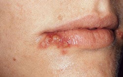 Example of a cold sore