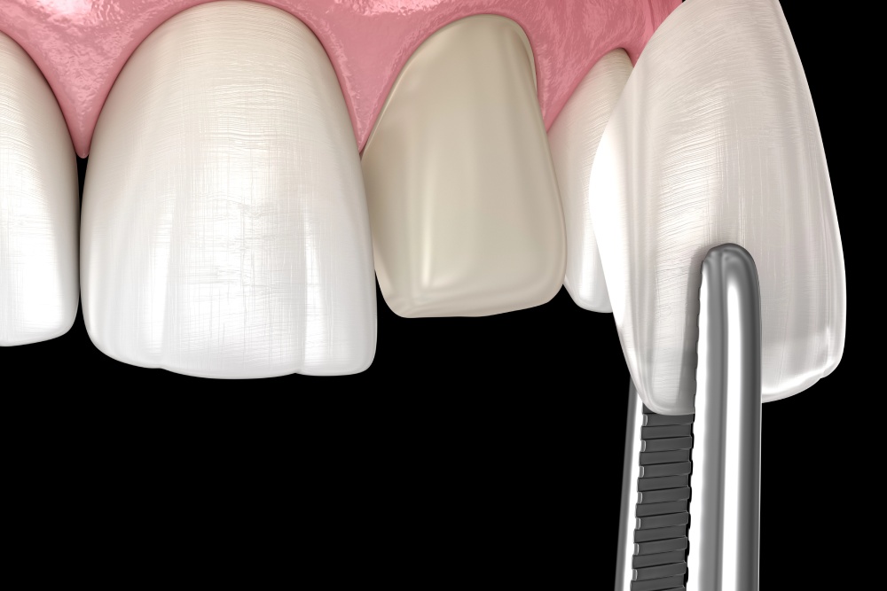 Composite Veneers Vs. Porcelain Veneers: What's The Difference?