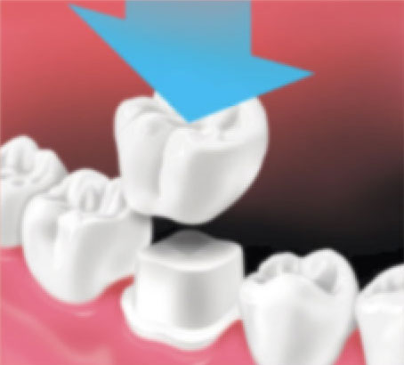 Crown is placed over prepared tooth