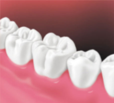After crown placement