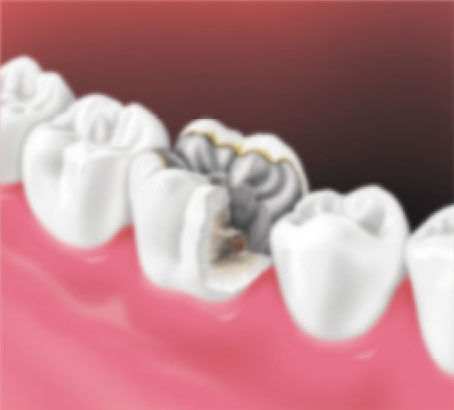 Before crown: Worn filling with decay under filling