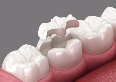 dental-bonding-on-tooth-model-img