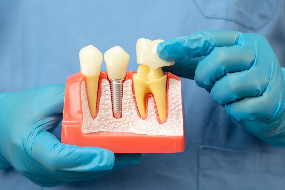 Dental Crowns: A Solution For Damaged Teeth