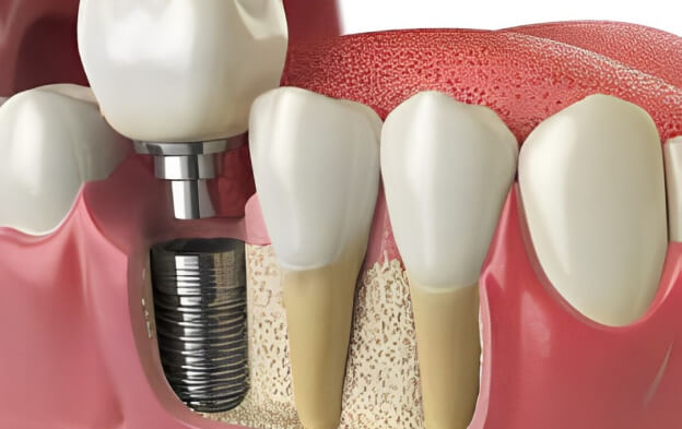 dental-implant-options-img01