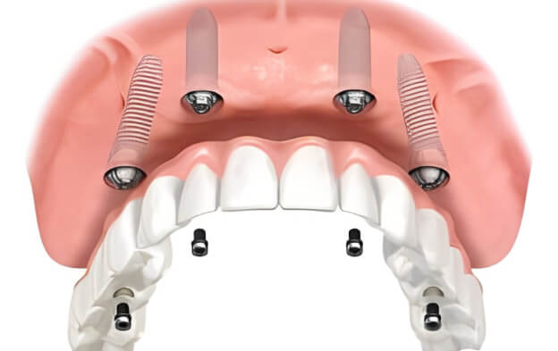 dental-implant-options-img03