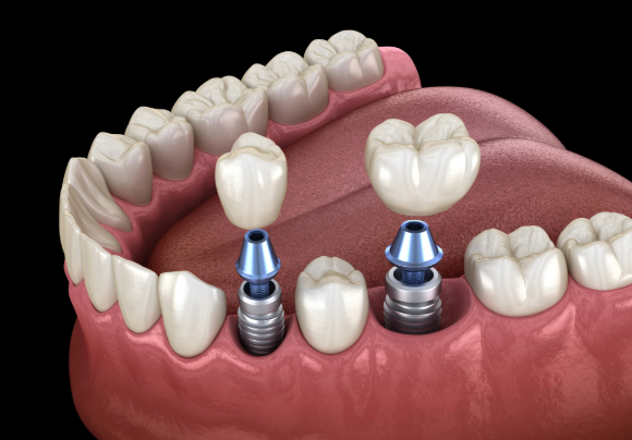Dental Implants Lifespan: How Long Do They Last?