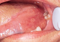 Example of Erythroplakia