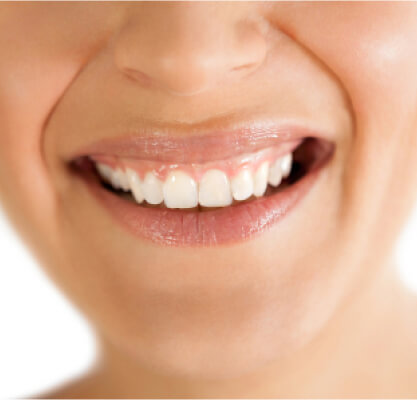 Gummy smile