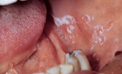 Example of Leukoplakia