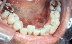 Example of Lichen Planus