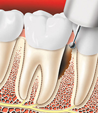 Diseased tissue is removed from the pocket. In some cases, the bone may be reshaped