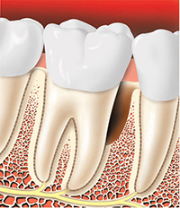 Bone has been reshaped