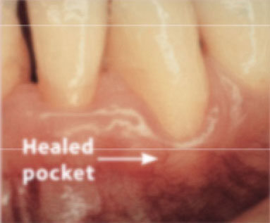 After treatment