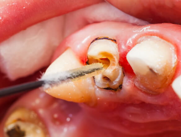 repair-chipped-teeth-img