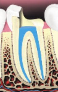 The root canals and pulp chamber is filled