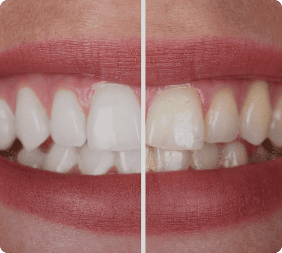 teeth-whitening_