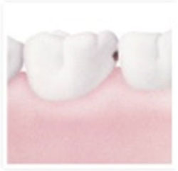Decay in between teeth