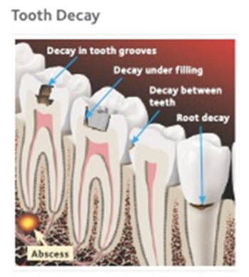 Tooth decay illustration