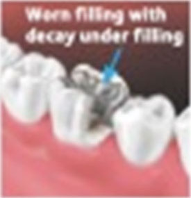 worn filling with decay under filling