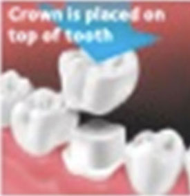 crown is placed on top of tooth