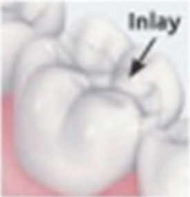 inlay