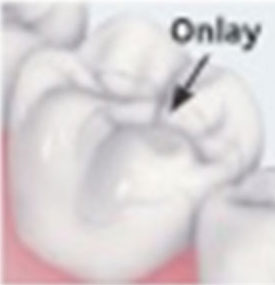 onlay